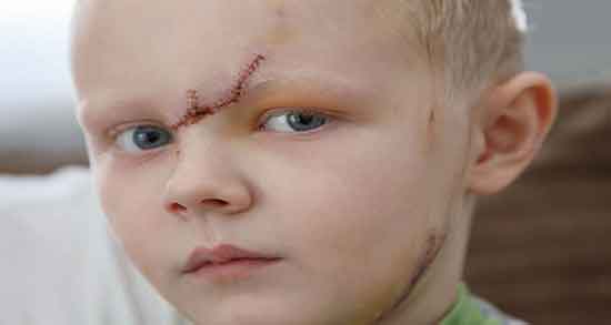 تعبیر خواب مرده صورت زخمی